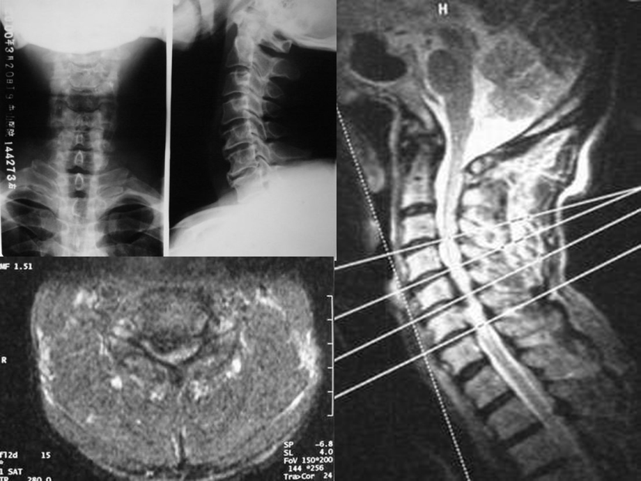 脊髓型颈椎病手术治疗方法选择课件.ppt_第3页