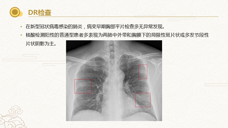 新冠肺炎-影像学教学提纲课件.ppt_第2页