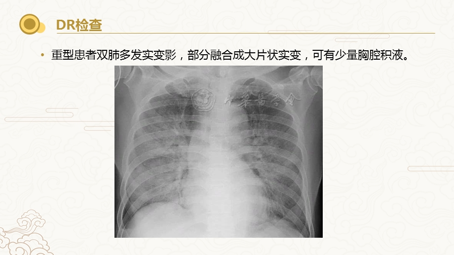 新冠肺炎-影像学教学提纲课件.ppt_第3页