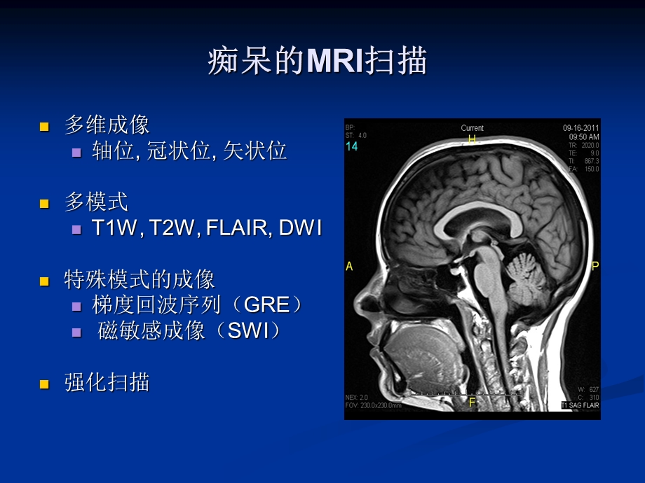 痴呆的影像学-课件.ppt_第3页