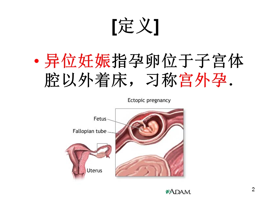 异位妊娠输卵管妊娠课件.ppt_第2页