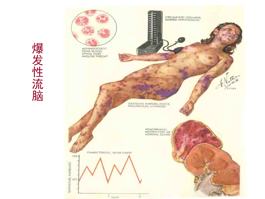 dic病理生理学.ppt_第3页