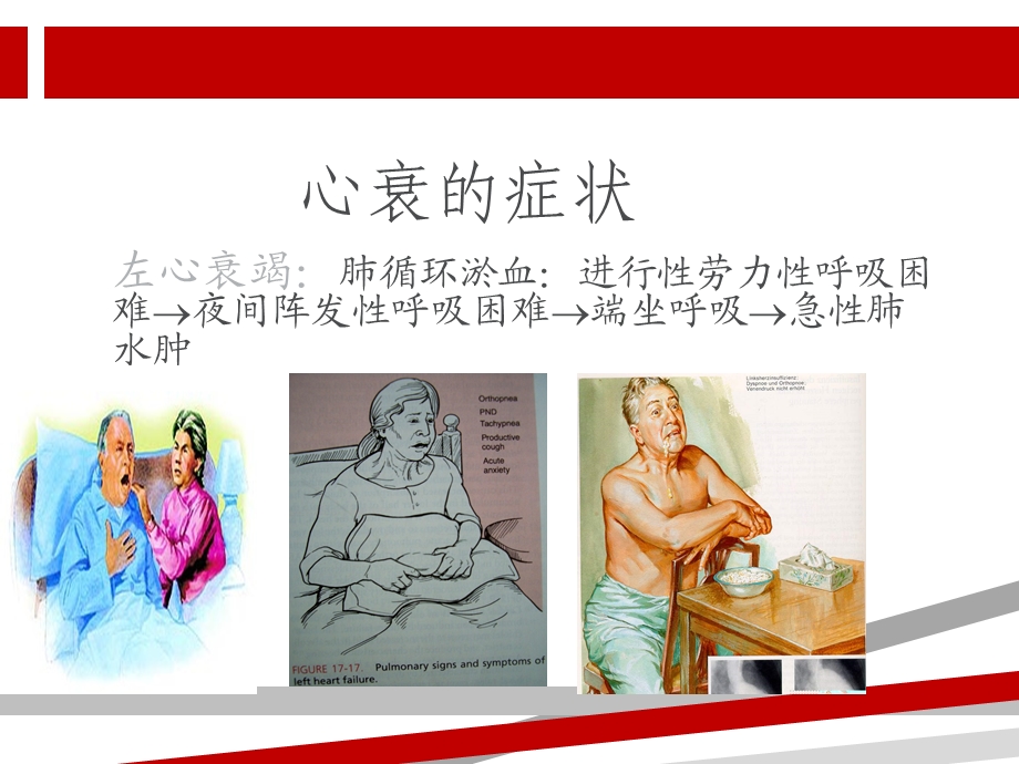 心衰患者的液体管理课件.ppt_第2页