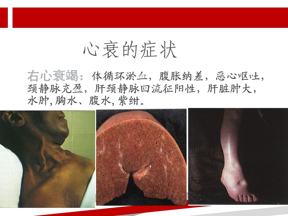 心衰患者的液体管理课件.ppt_第3页