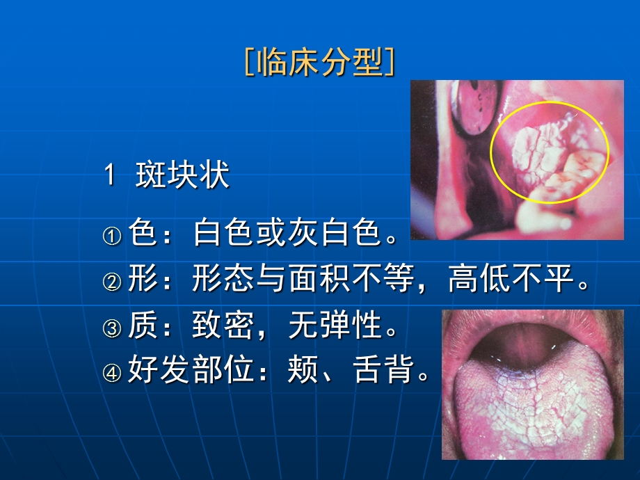 口腔粘膜病课件.ppt_第3页