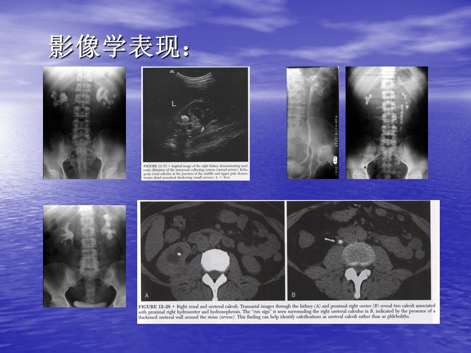 尿石症的微创治疗课件.ppt_第3页