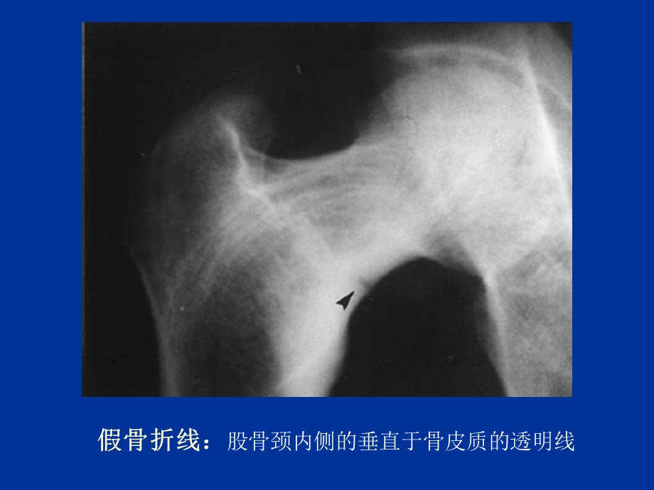 代谢性骨病4-课件.ppt_第3页