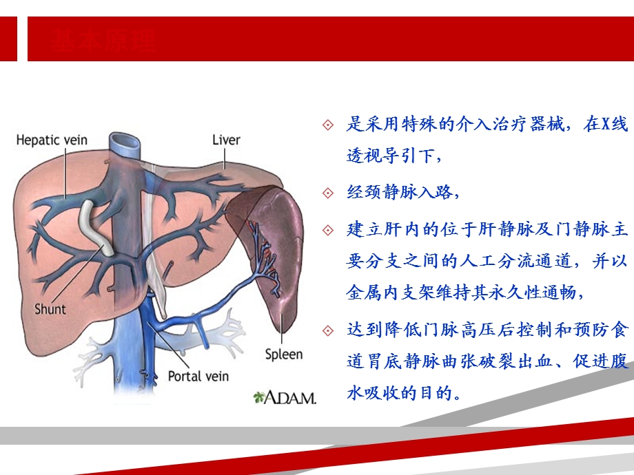 经颈静脉肝内门体静脉分流术课件.ppt_第3页