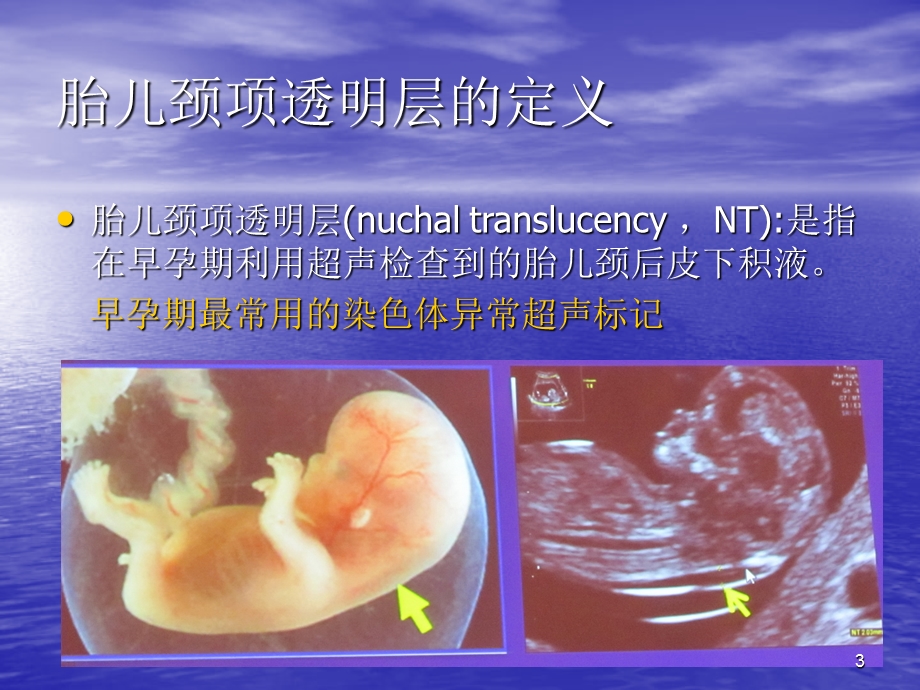 胎儿NT测量标准与临床意义医学课件.ppt_第3页