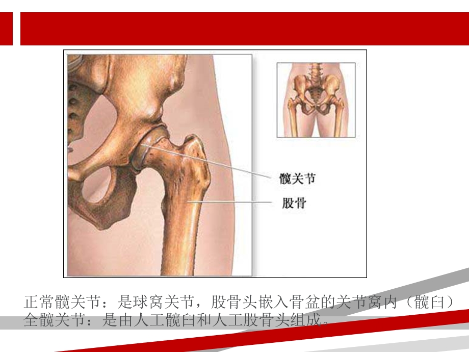 全髋关节置换术后的护理ppt课件演示.ppt_第3页