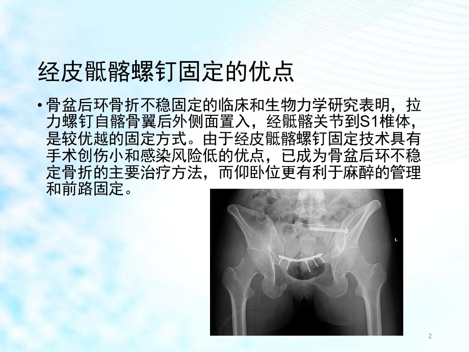 仰卧位C臂透视下经皮骶髂螺钉固定治疗骶髂关节损伤学习ppt课件.ppt_第2页