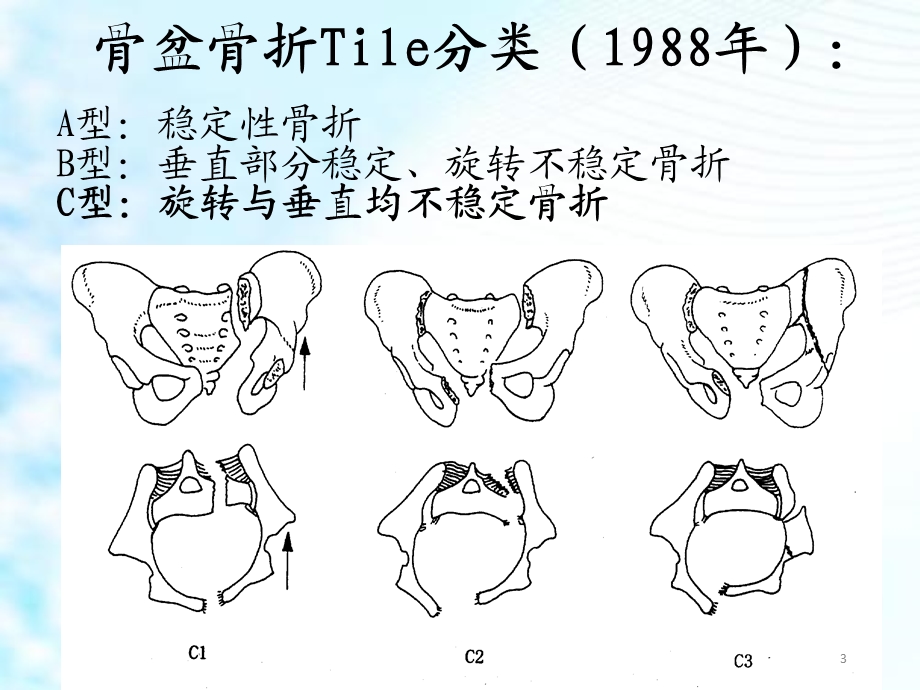 仰卧位C臂透视下经皮骶髂螺钉固定治疗骶髂关节损伤学习ppt课件.ppt_第3页