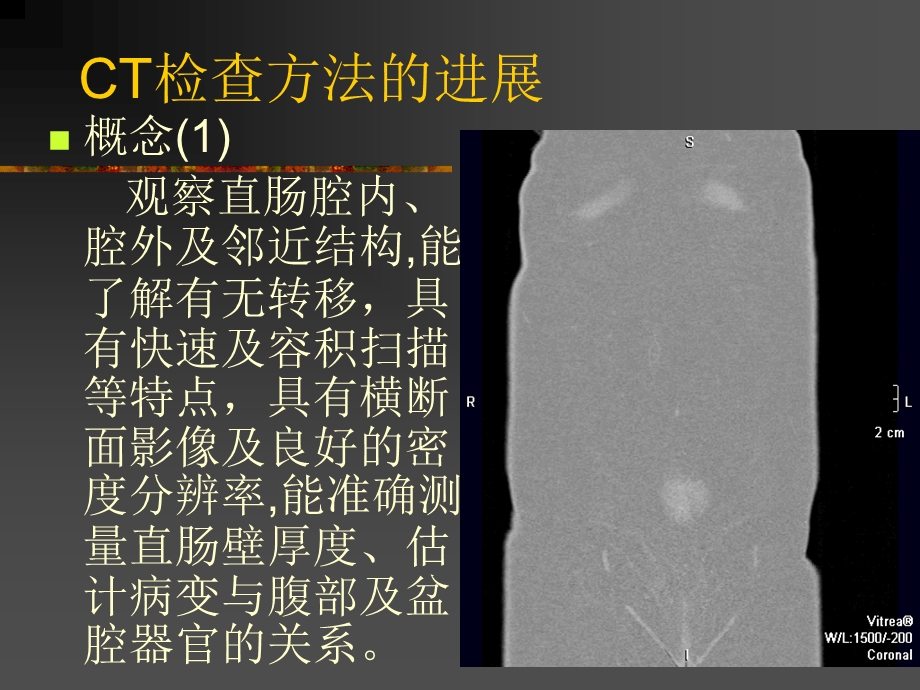 结直肠癌的CTMRI影像进展课件.ppt_第3页