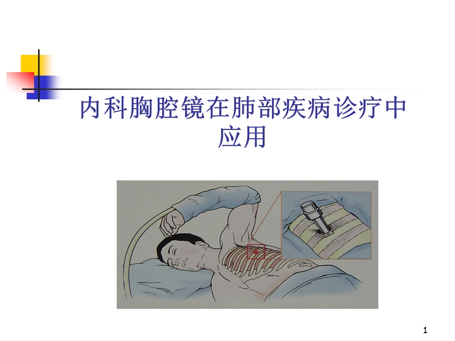 内科胸腔镜演示ppt课件.ppt_第1页