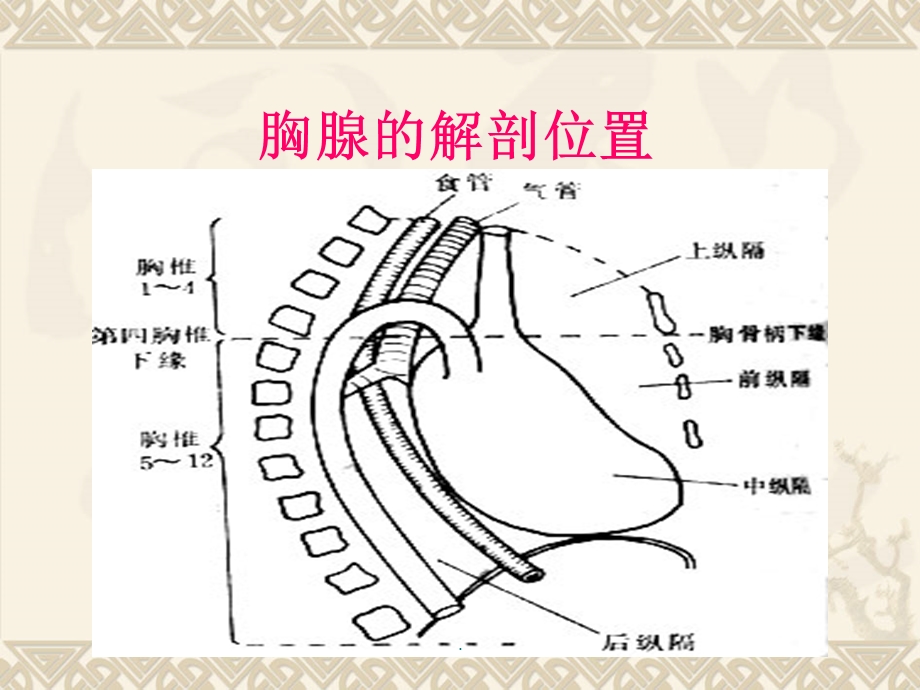 胸腺瘤合并重症肌无力患者的护理课件.ppt_第3页