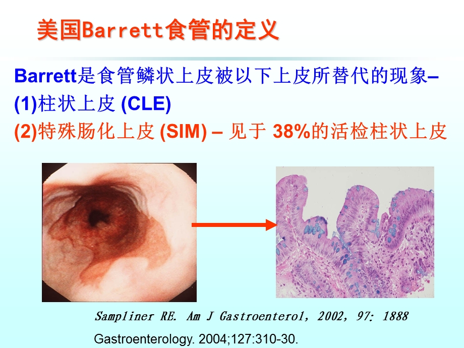 barrett食管诊断与治疗课件.ppt_第2页