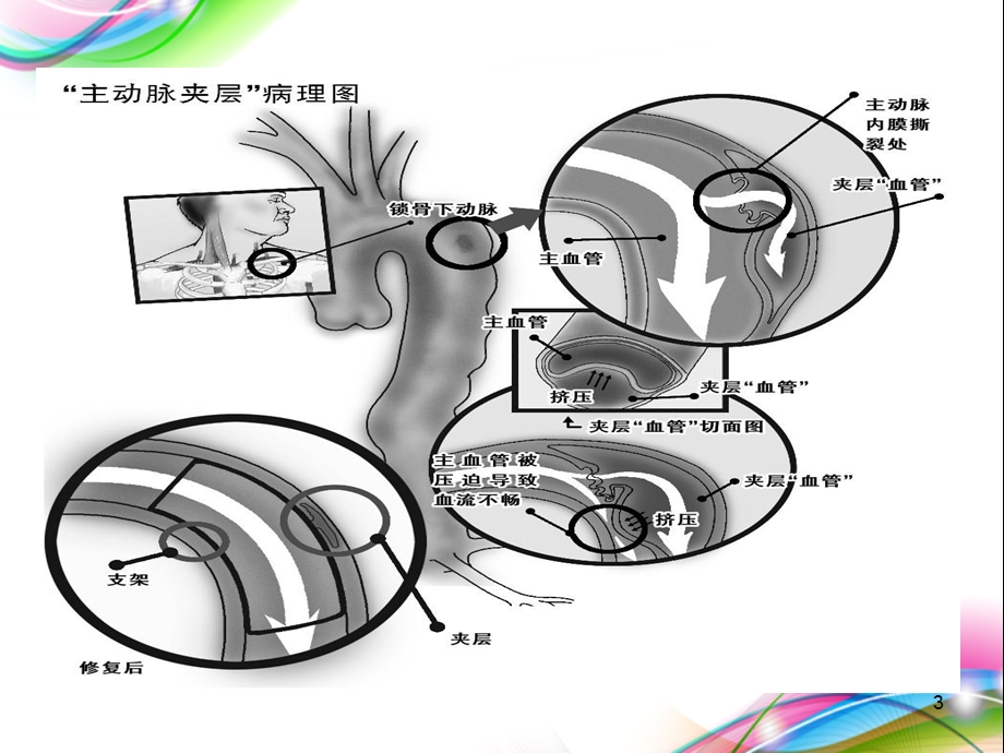 主动脉夹层护理查房医学课件.ppt_第3页