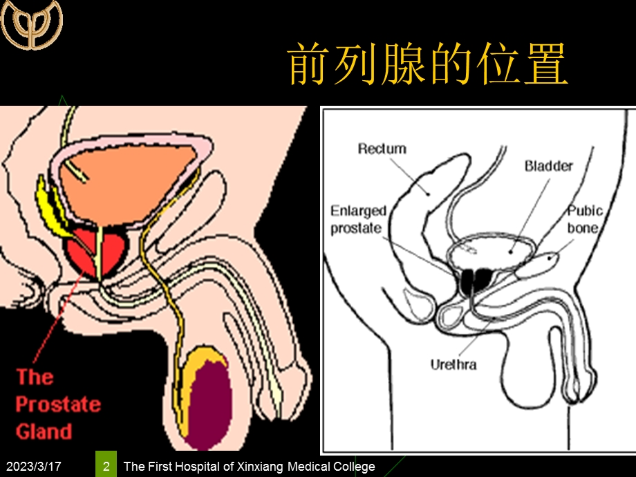 55章良性前列腺增生课件.ppt_第2页