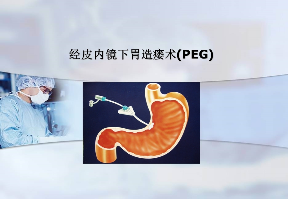 经皮内镜下胃造瘘术课件.ppt_第1页