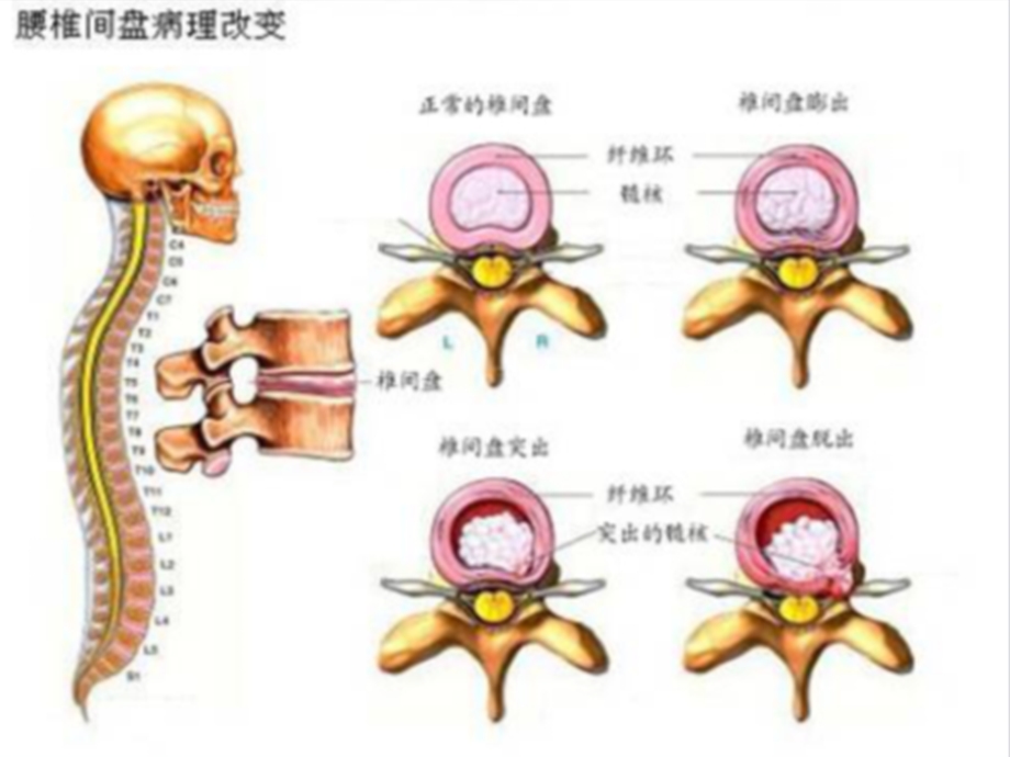 腰椎间盘突出的功能锻炼和健康教育资料汇编课件.ppt_第3页