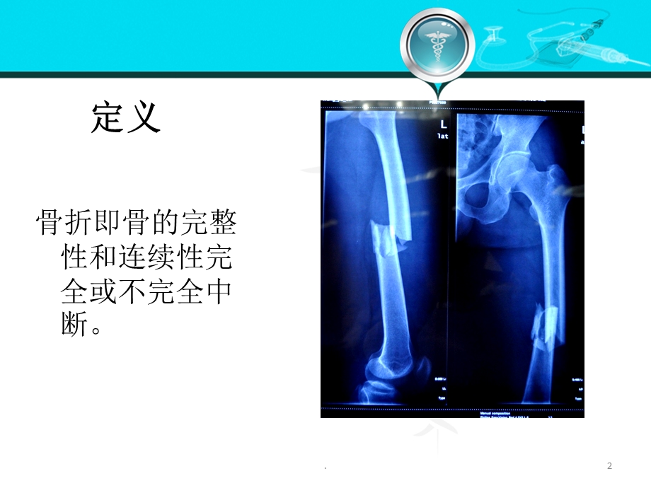 骨折X线课件.ppt_第2页