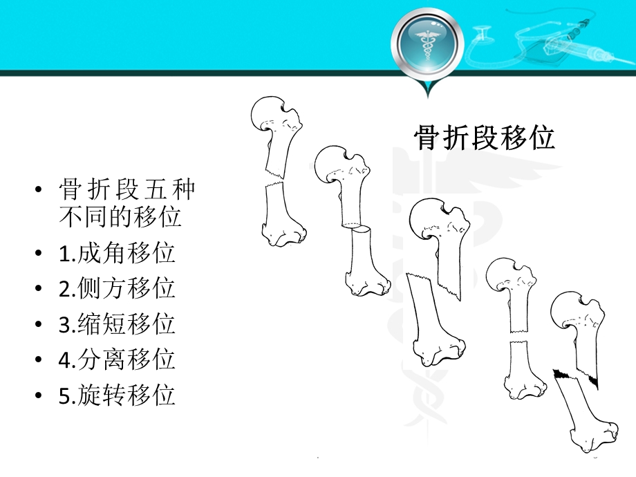 骨折X线课件.ppt_第3页