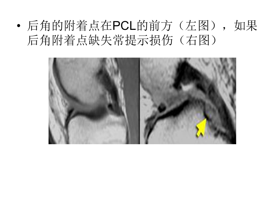 半月板的影像学表现.ppt_第3页