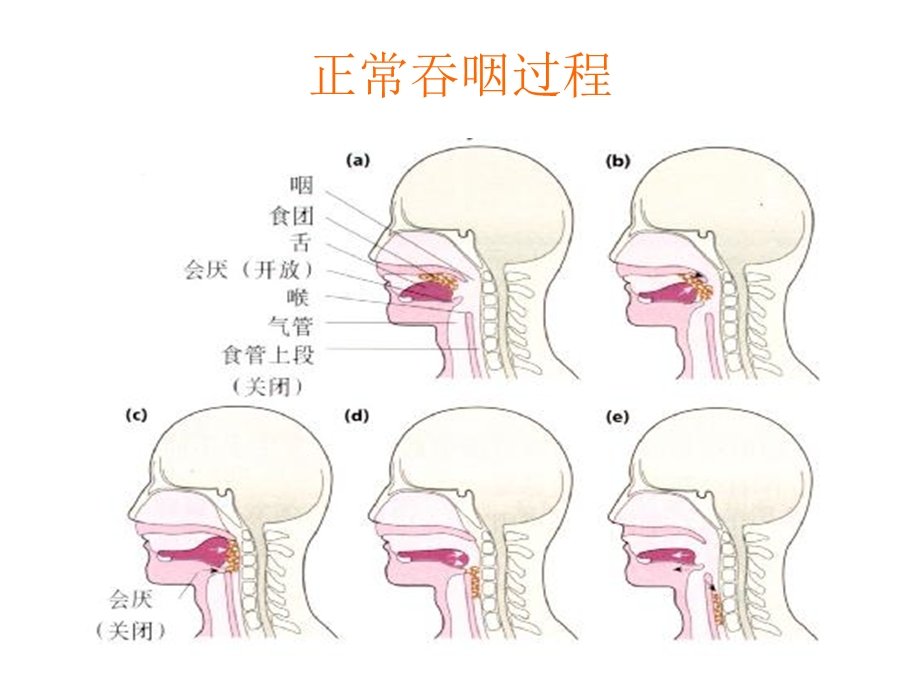 吞咽障碍护理.ppt.ppt_第2页