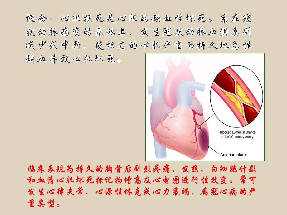 心肌梗死的护理常规.ppt.ppt_第2页