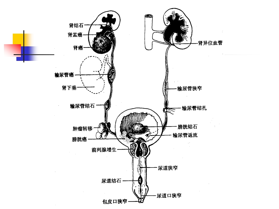 泌尿系梗阻的诊断与治疗 必尿科.ppt_第2页