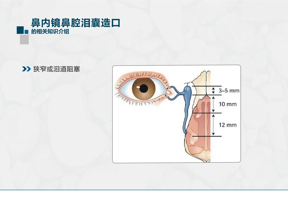 2145005211鼻内镜鼻腔泪囊造.ppt_第3页