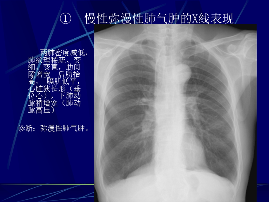 呼吸系统基本病变影像表现.ppt_第3页