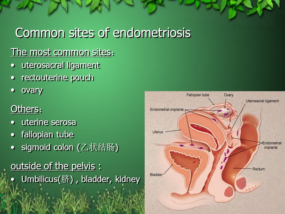 子宫内膜异位症(endometriosis)张喜.ppt_第3页