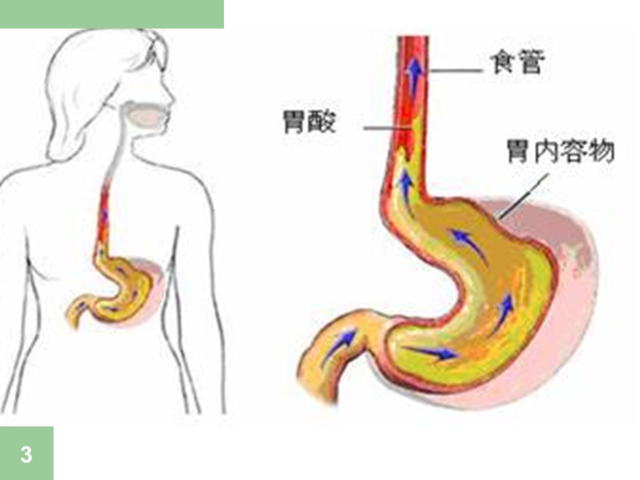 胃食管反流病讲义.ppt_第3页