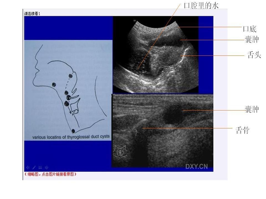 【讲座】颈部常见肿物的超声诊断.ppt_第3页