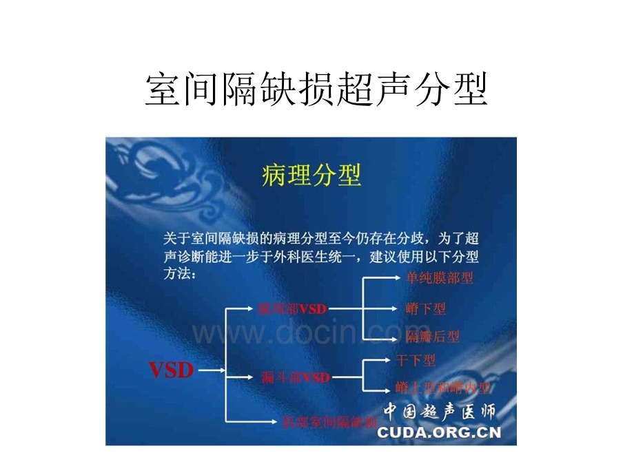 室间隔缺损超声分型.ppt_第1页