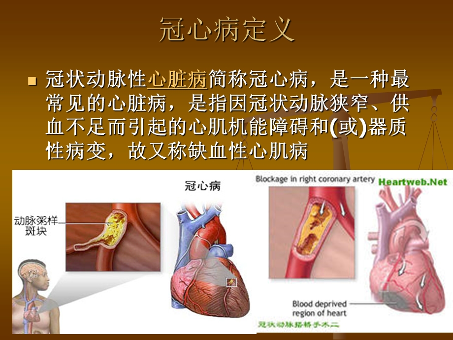 冠心病(CHD).ppt_第2页