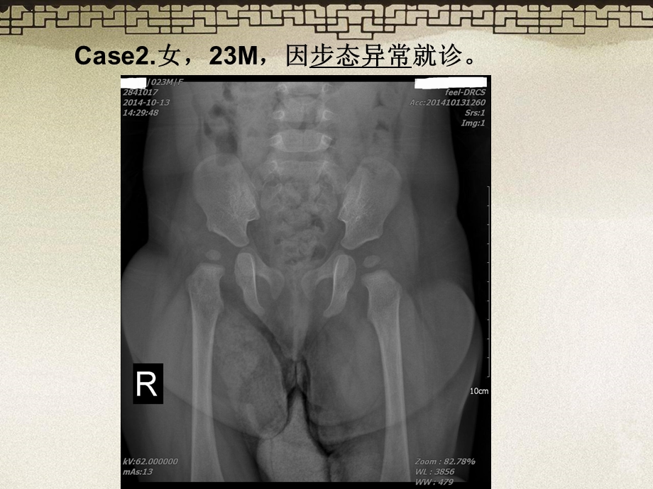 DDH发育性髋关节脱位.ppt_第3页