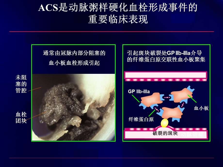 4555093199acs抗血小板治疗泰嘉.ppt_第2页