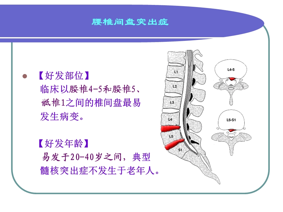 腰椎间盘突出症2.ppt_第3页