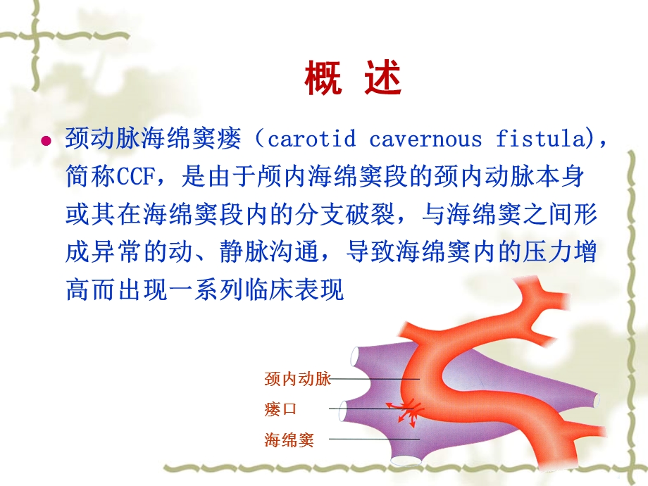 颈内动脉海绵窦瘘的治疗与护理第四军医大学唐都医院功能神经外科王学廉.ppt_第3页