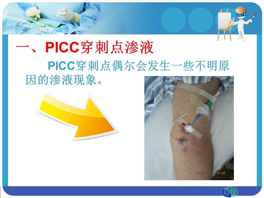 picc穿刺点渗液与皮肤过敏的处理图文.ppt_第2页
