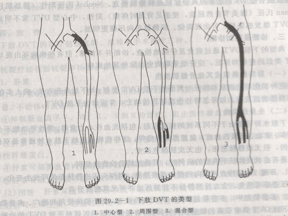 压力泵的临床应用.ppt_第3页