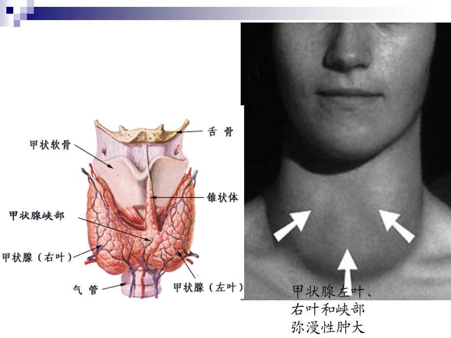 甲亢危象.13).ppt_第2页