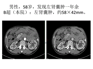 肾恶性肿瘤病例讨论课件.ppt