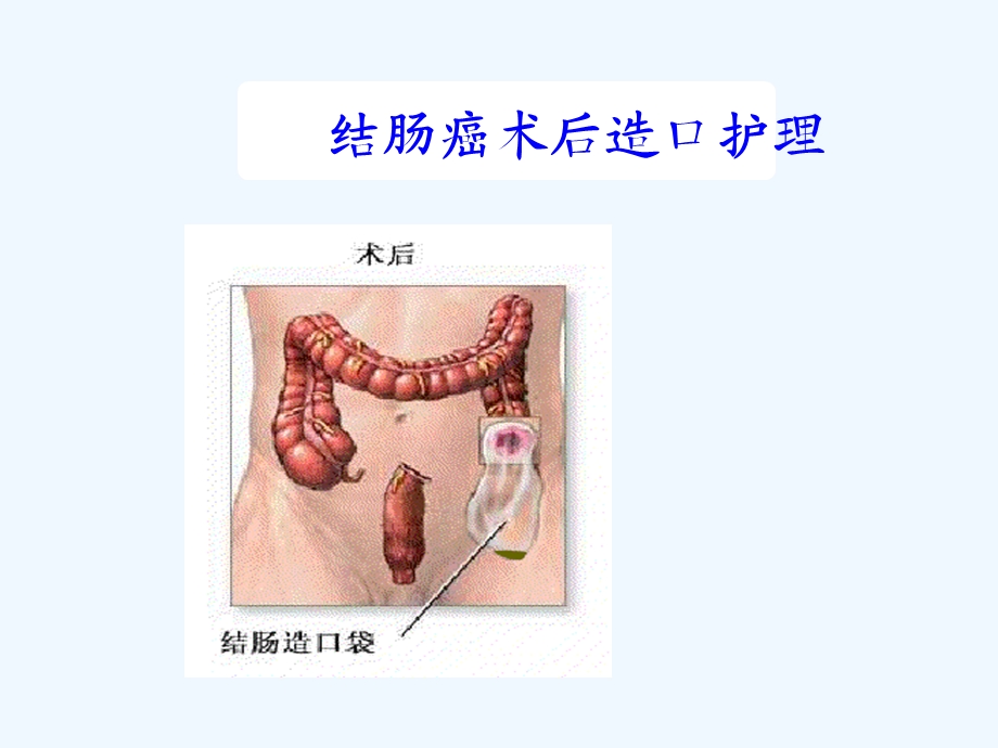 肠癌术后造口的护理教学查房课件.ppt_第1页