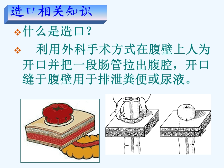 肠癌术后造口的护理教学查房课件.ppt_第3页