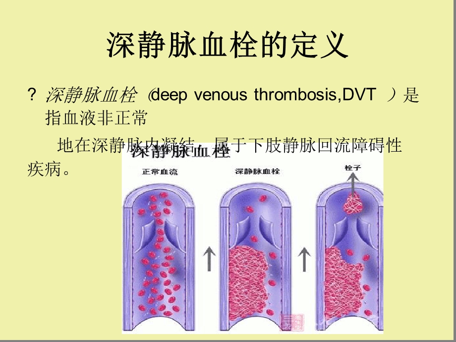 深静脉血栓评价课件.ppt_第2页