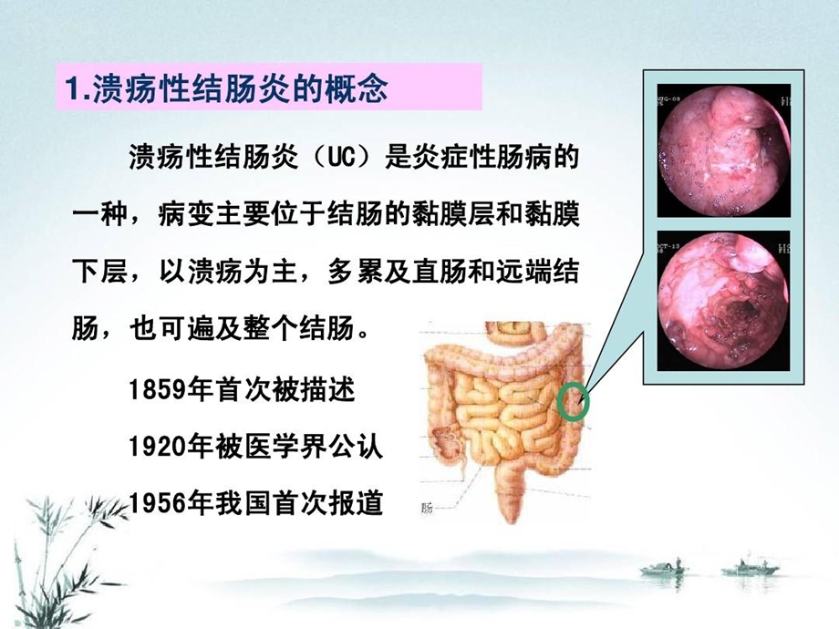 溃疡性结肠炎中西医研究课件.ppt_第3页