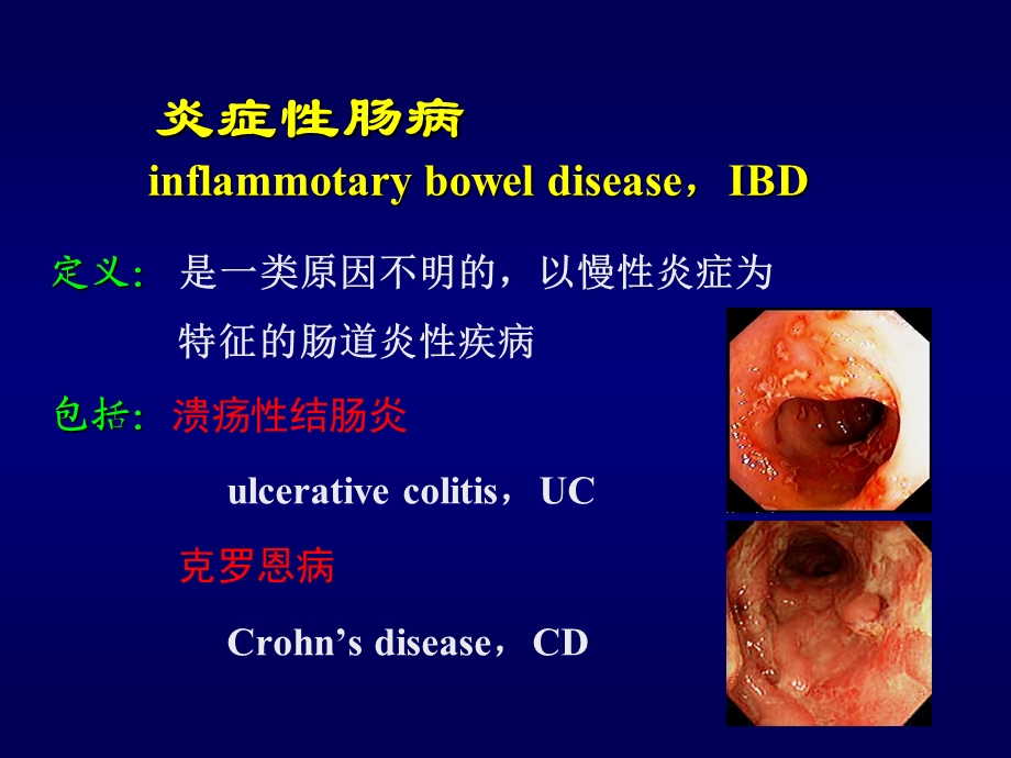 溃疡性结肠炎Ulcerativecolitis课件.ppt_第2页